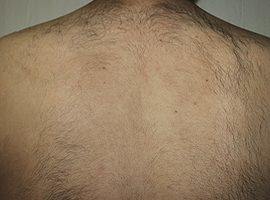 removal laser hair tahiliani sushil md courtesy