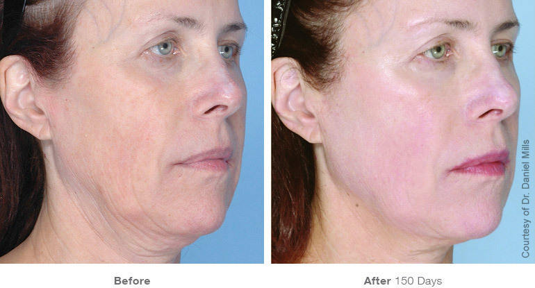 before_after_ultherapy_results_full-face22_v3