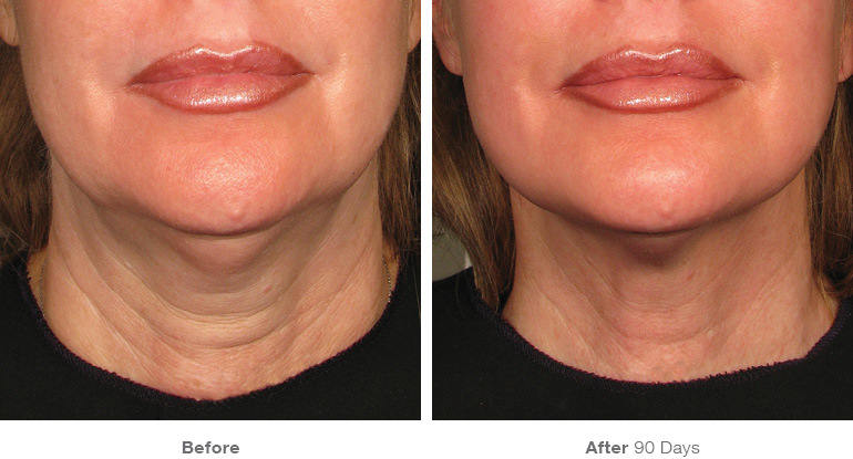 before_after_ultherapy_results_neck3
