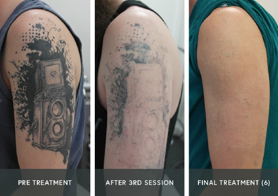 8. Hydrogen Peroxide Tattoo Removal: How Many Sessions Are Needed? - wide 5