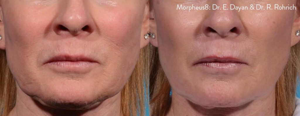 Morpheus 8 Dr. Rohrich Before & After image