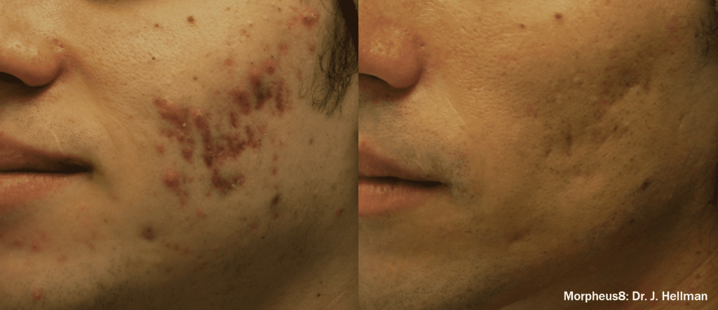 Morpheus 8 Dr. Hellman Before & After image