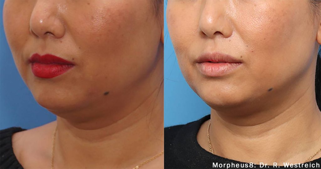 Morpheus 8 Dr. Weistreich Before & After image