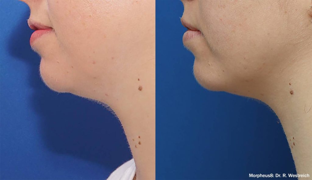 Morpheus 8 Dr. Westreich Before & After image