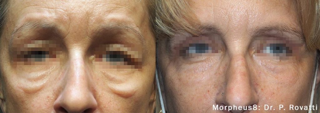 Morpheus 8 Dr. Rovatti Before & After image