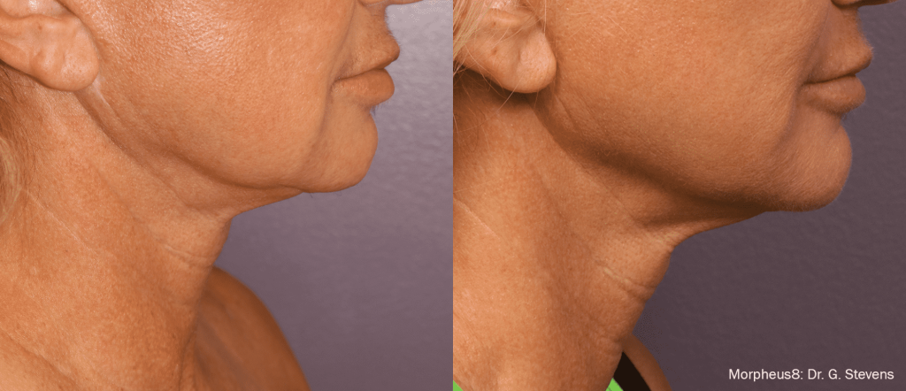 Morpheus 8 Dr. Stevens Before & After image